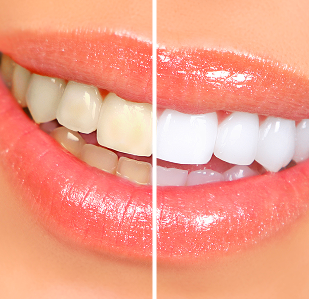 Dentisterie esthétique - Blanchiment dentaire - Blanchiment des dents - Clinique de santé dentaire Tammy Raymond