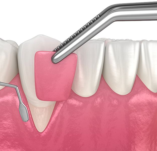 Chirurgies dentaires - Greffes de gencives - Greffe gingivale - Clinique de santé dentaire Tammy Raymond