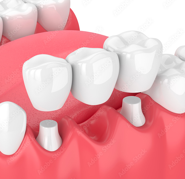 Dentisterie esthétique - Pont dentaire fixe - Clinique de santé dentaire Tammy Raymond