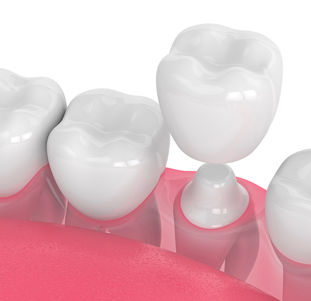 Dentisterie esthétique - Facette et restauration de céramique - Clinique de santé dentaire Tammy Raymond